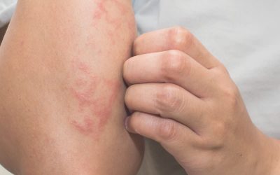 Cómo tratar el eczema atópico: ¿pueden ayudar los cosméticos de cáñamo?